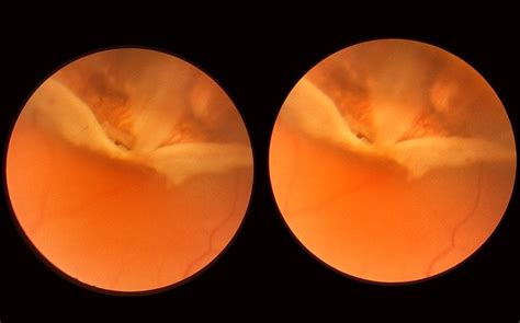 Dialysis Of Retina In Upper Nasal Quadrant Retina Image Bank