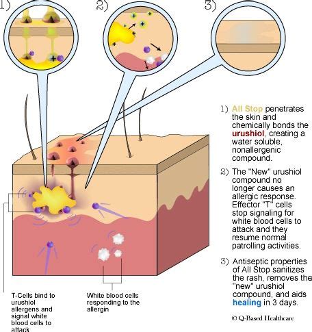 We did not find results for: poison ivy rash | Poison ivy remedies, Poison ivy rash ...