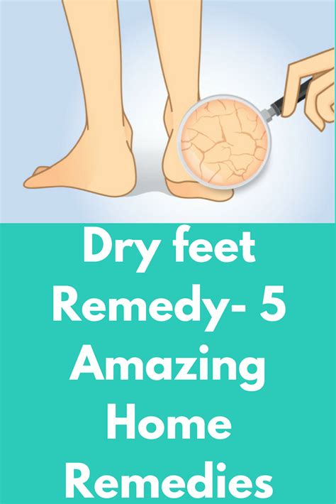 Dry Feet Remedy 5 Amazing Home Remedies So You Went To Try On A Pair
