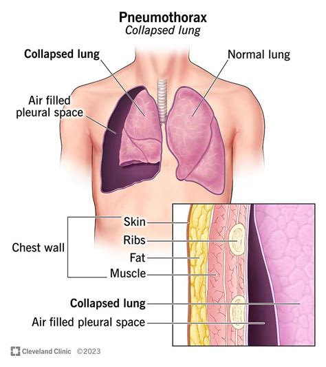 Pneumothorax Collapsed Lung Symptoms Treatment