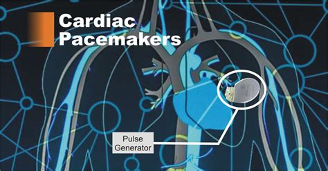 Pacemaker Of The Heart External And Implantable Pacemakers Medical