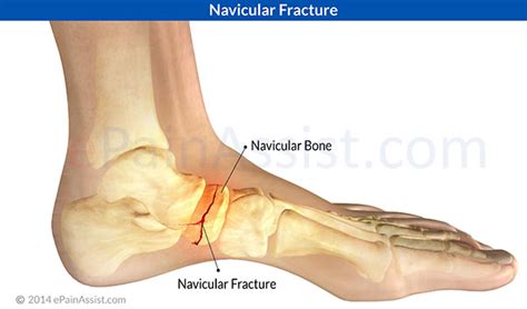 Navicular Fracturesymptomscausestreatment Cast Sports Massage Rehab
