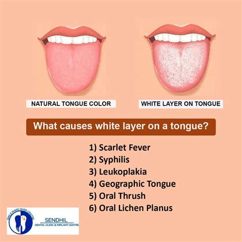 White Colored Tongue White Layers Geographic Tongue Tongue