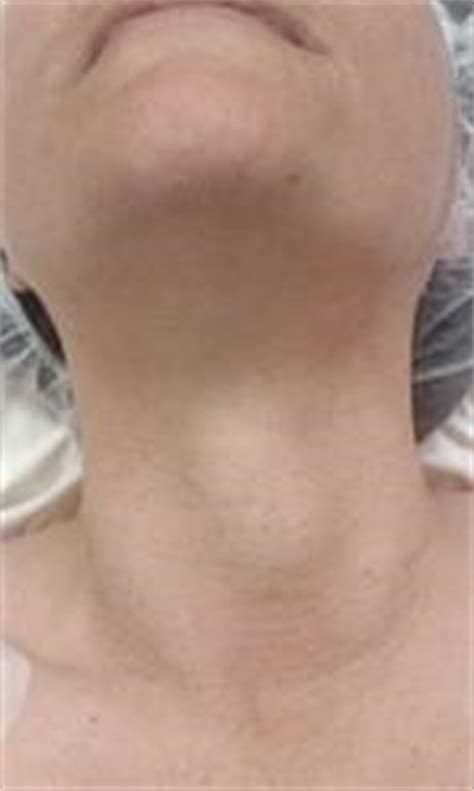 Thyroid nodules are a common finding in the general population. Thyroid Surgery « Western ENT
