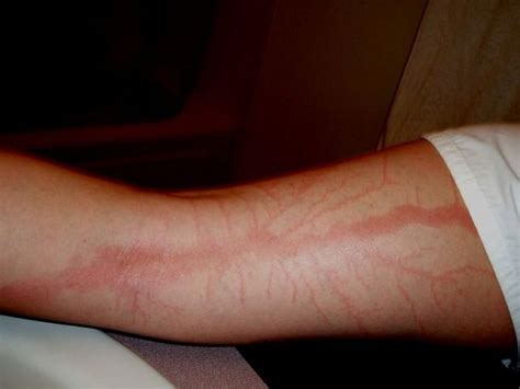 Incredible Photos Reveal What Happens To Your Skin If You Re Struck By Lightning Wsbuzz Com
