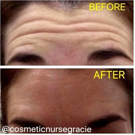 Botox Before And After Pictures Forehead 2 Facelift Info Prices