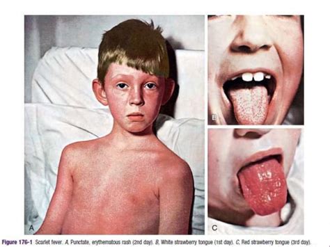 scarlet fever infectious diseases
