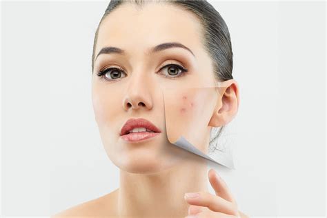 Best Acne Treatment Singapore Plan