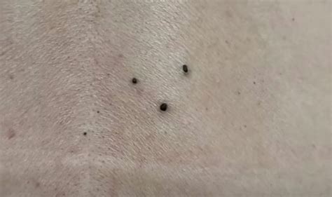 Large Blackheads And Cysts On Back Removed New Pimple Popping Videos