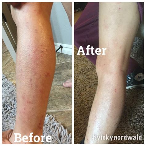 Eczema Rash On Legs Treatment