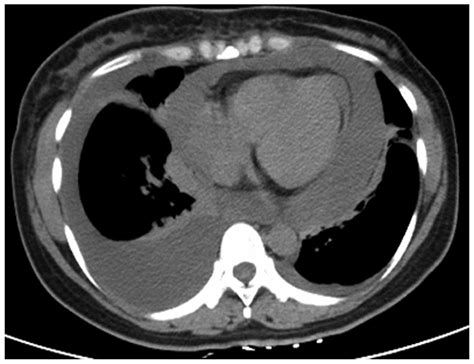 Malignant Pleural And Pericardial Effusions And Meningeal Infiltrates