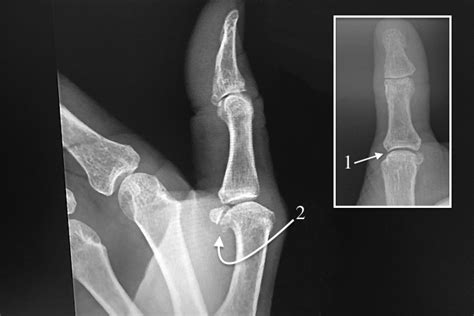 Osteoarthritis Fingerthumb Mp Pip Dip And Ip Hand Surgery Source