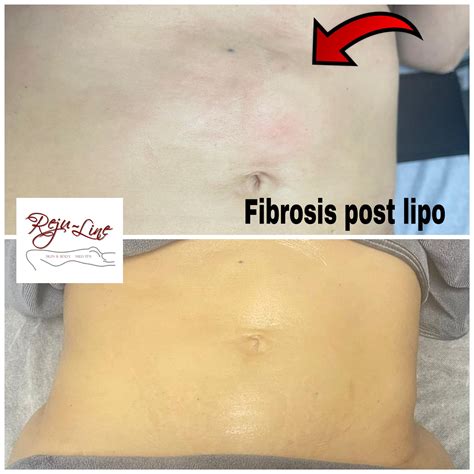 Lymphatic Drainage Post Liposuction Rejuline Skin And Body Med Spa