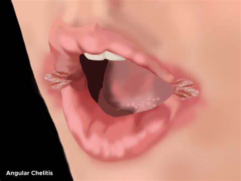 Figure Illustration Of Cracks In Corners Of Mouth Due To Angular Chelitis Contributed By