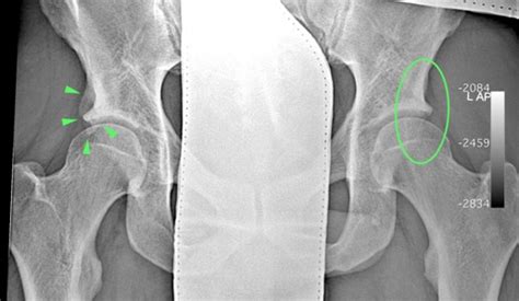 Anterior Inferior Iliac Spine Avulsion Fracture Faqs Hip And Pelvis