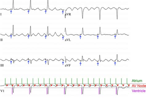 Atrial Flutter With Narrow Qrs Complexes In A Patient With Pacemaker