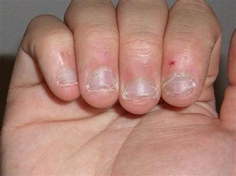 7 Effective Ways To Stop Biting Your Nails Parhlo