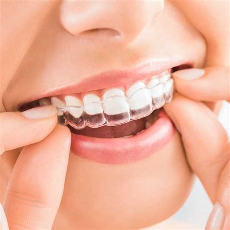 Book An Invisalign Invisible Braces Consultation At Dentobeauty Grays Essex