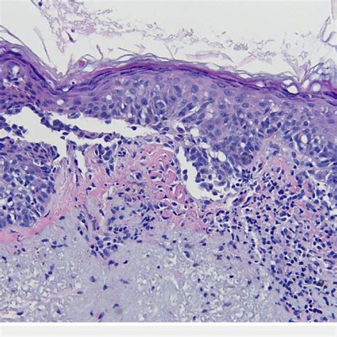 Microscopic Examination Of The Lentigo Maligna Melanoma Biopsy