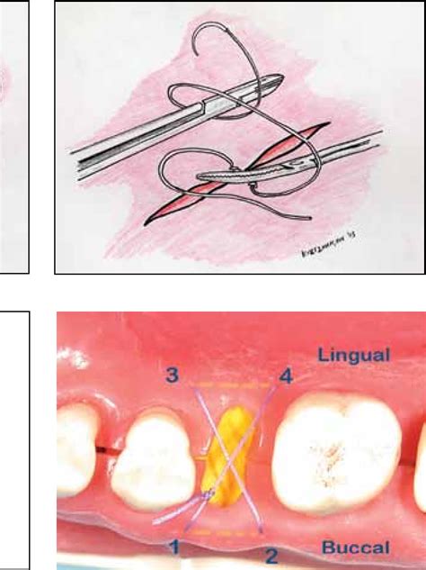 Figure 1 From Suturing For Surgical Success Semantic Scholar