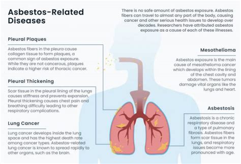 Asbestos Related Diseases Asbestosis And Pleural Plaques