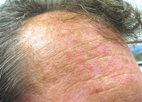 Actinic Keratosis What Is It How Is It Treated At Apollo Dermatology