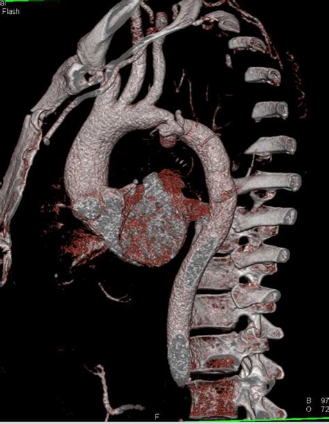 Coarctation Of The Aorta With Collaterals Best Seen On The Sagittal