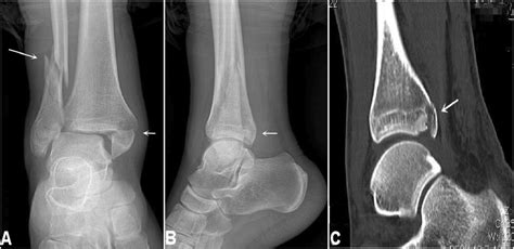Medial Malleolus Fracture And High Location Fibular Fracture A The
