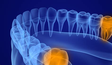 Painless Wisdom Teeth And Dental Extractions 24h Emergency