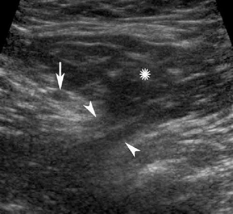 Indirect Inguinal Hernia In A 56 Year Old Woman With Hip Arthroplasty Download Scientific