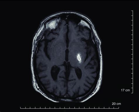 T1 Weighted Mri Image Showing A Hyperintense Lesion Due To A Small