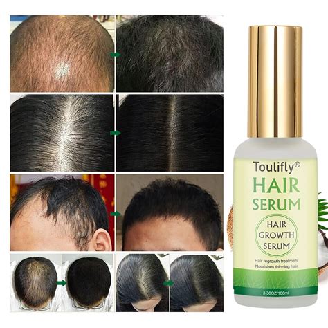 Hair Growth Serum Hair Loss And Hair Thinning Treatment Stops Hair Loss