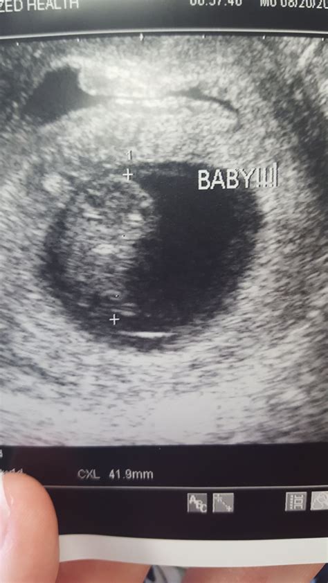 Post Your Ultrasounds Here Page 3 — The Bump