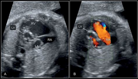 Hypoplastic Left Heart Syndrome And Critical Aortic Stenosis Obgyn Key