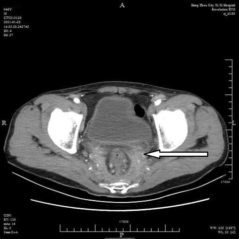 Retroperitoneal Fibrosis In Ct Before The Treatment Download