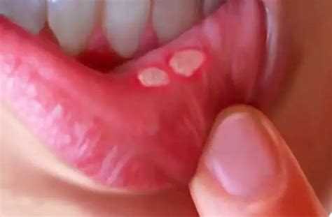 Aphthous Ulcer Photo Causes Symptoms Treatment And Prevention Dentistry