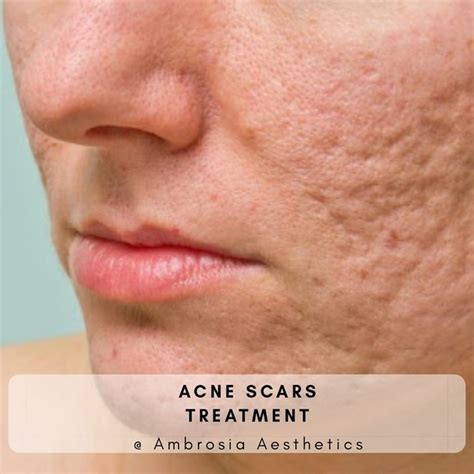 What Is The Cost Of Laser Treatment For Acne Scars In