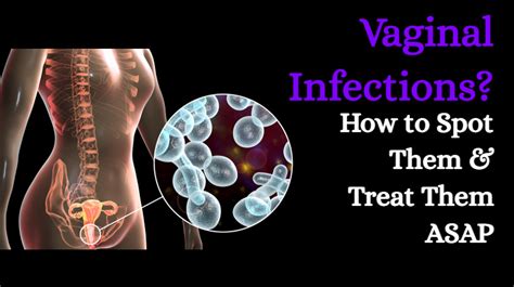 Vaginal Infections How To Spot Them Treat Them ASAP WomenWorking