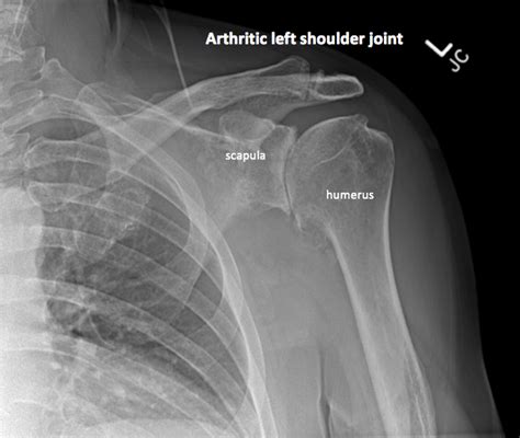 Shoulder Xray Century City Los Angeles Ca Commons Clinic