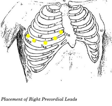 Right Precordial Leads Edited