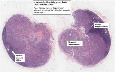 Breast Carcinoma With Lymph Node Metastases Nus Pathweb Nus Pathweb
