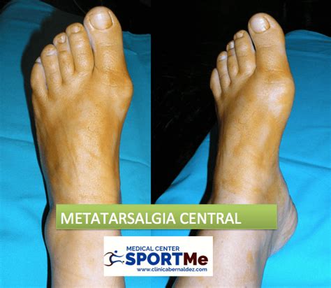 Metatarsalgia Dolor Planta Del Pie Clínica Bernáldez Sportme