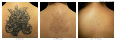Picosure Laser Tattoo Removal Before And After Maritza Brinkley
