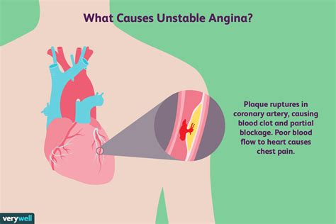 Unstable angina is a medical emergency, and people should seek medical help if they experience new, worsening, or persistent chest pain or discomfort. Unstable Angina: Overview and More