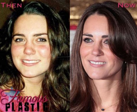Kate Middleton Plastic Surgery Before And After Nose Job And Botox