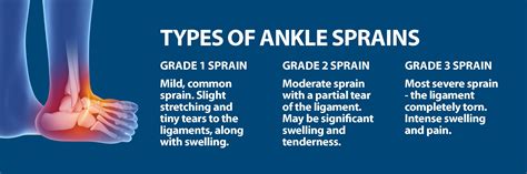 We did not find results for: Sprained Ankle | Florida Orthopaedic Institute