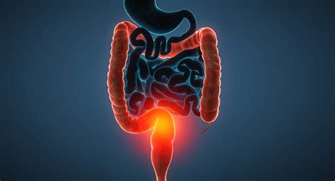 How To Test For Ulcerative Colitis Ulcerative Colitis Uc Is An