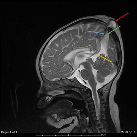 Atretic Parietal Cephalocele Apc Pacs