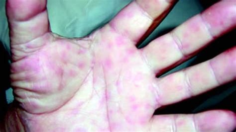 Meningococcal Disease Deadly Bacterial Infection On The Rise In