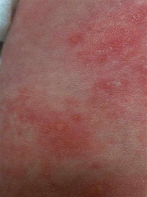 Причины, симптомы, диагностика и лечение сепсиса. re: What is this newborn rash? - dermatology - 99nicu ...